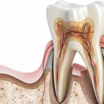 Leczenie kanałowe martwego zęba